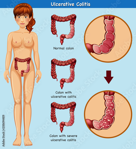 Human Anatomy of Ulcerative Colitis
