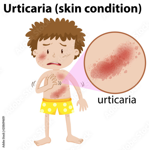 A Young Man Having Urticaria