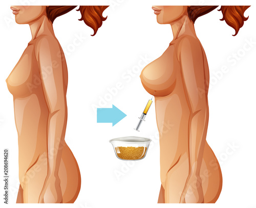 Breast augmentation fat transfer method