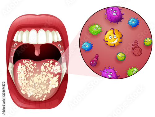 A Human Mouth Virus Infection