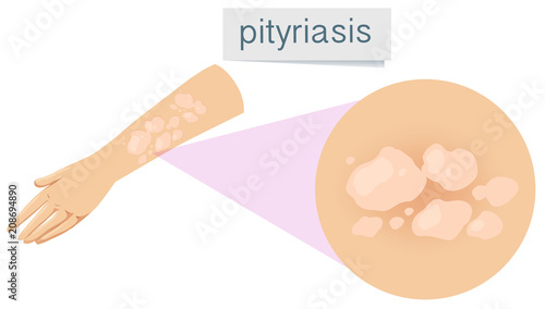 A Pityriasis on Human Skin