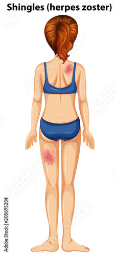 Women with shingles herpes zoster
