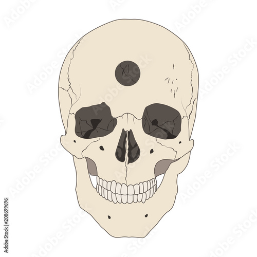 Human realistic skull with a hole. Trepanation, ancient surgery. White background. Flat vector illustration.