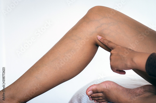 Concept skin health,Close up of varicose veins on the woman legs