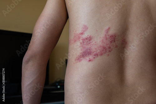 close up on herpes zoster on the back