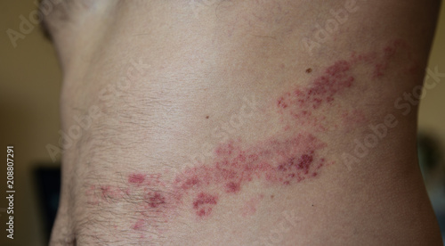 close up on herpes zoster on the stomach