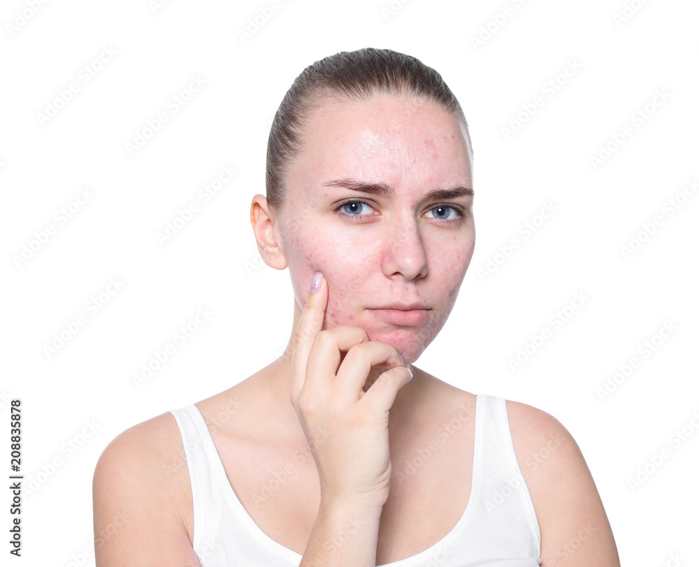 Young woman with acne problem on white background Young woman with acne problem on white background