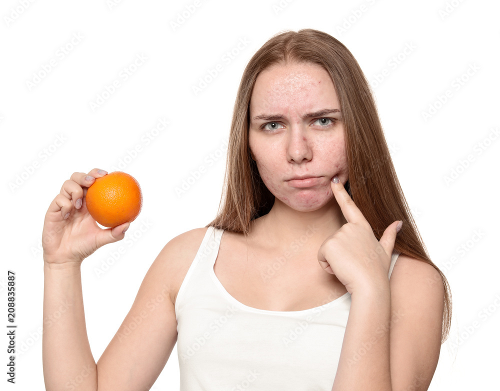 Young woman with acne problem holding orange on white background. Skin allergy