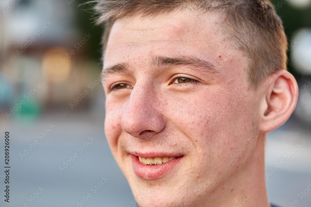 A young happy guy with problem skin having fun while walking around the summer city. A young happy guy with problem skin having fun while walking around the summer city.