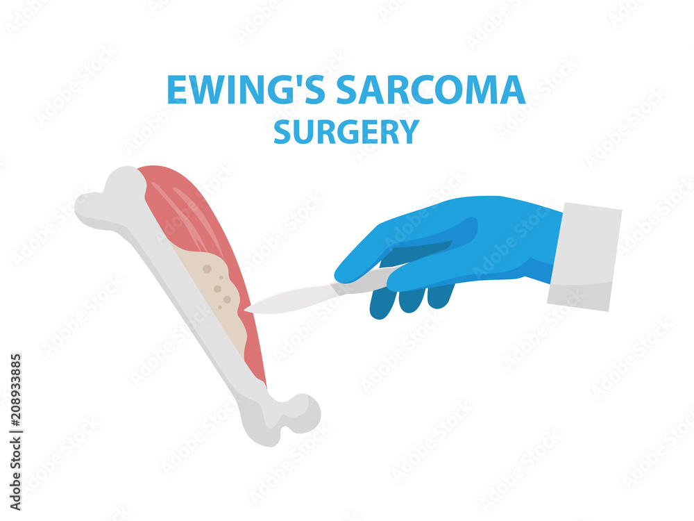 Ewing's sarcoma surgery vector illustration isolated on white background in flat design. Medical infographic elements with surgeon s hand keeping scalpel and doing surgery and removing cancer tumor. Ewing's sarcoma surgery vector illustration isolated on white background in flat design. Medical infographic elements with surgeon s hand keeping scalpel and doing surgery and removing cancer tumor.