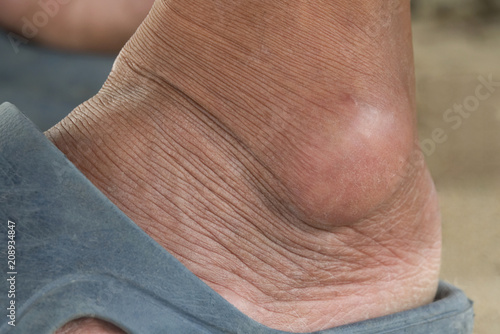 Close-up gout on a foot