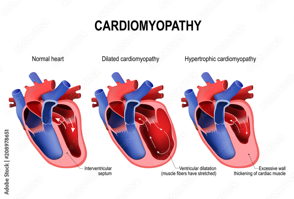 Hypertrophic Cardiomyopathy Dilated Cardiomyopathy And Healthy Heart hypertrophic-cardiomyopathy-dilated-cardiomyopathy-and-healthy-heart