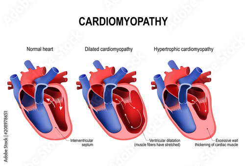 hypertrophic cardiomyopathy, dilated cardiomyopathy and healthy heart photo