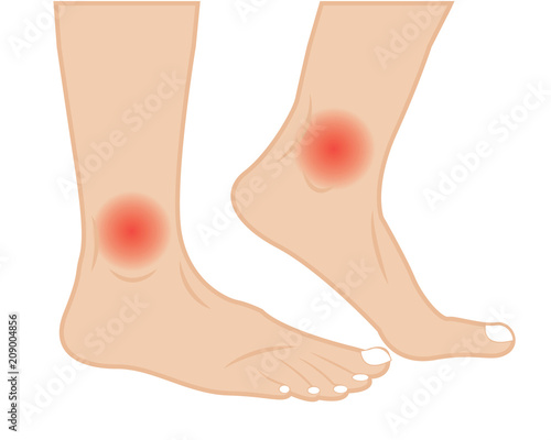 Ankle joint pain  treatment  vector illustration.  