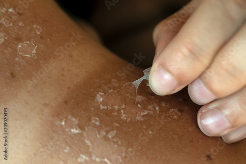 Peeling skin at back and shoulder from sunburn effect. Holidays and relaxation, abstract summer season background