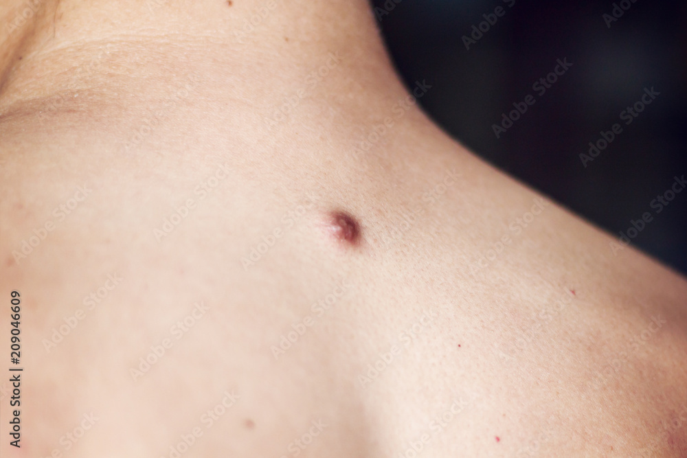 Fibroma on the male back, details, close-up Fibroma on the male back, details, close-up