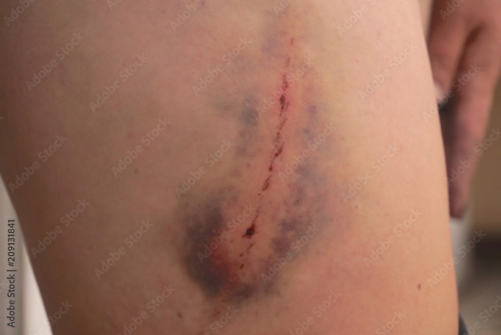 Fototapeta premium wound and bruise on the leg