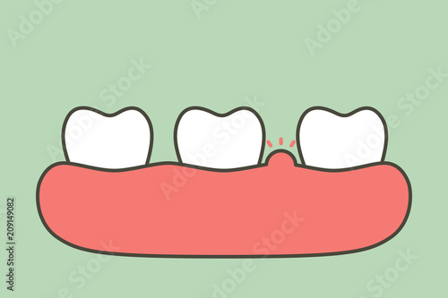 periodontitis or gum disease with swell - teeth cartoon vector flat style