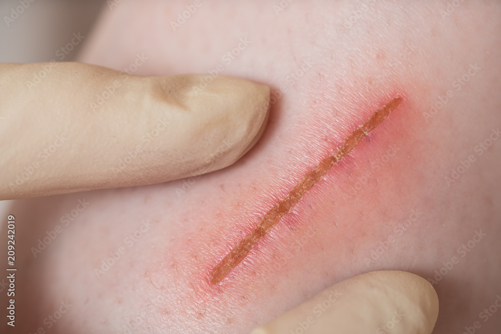 Fototapeta premium close up scar on skin