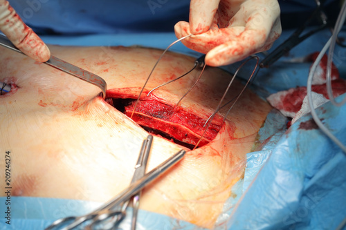 Surgeon carries out the osteosuture of the patient's sternum during surgery photo