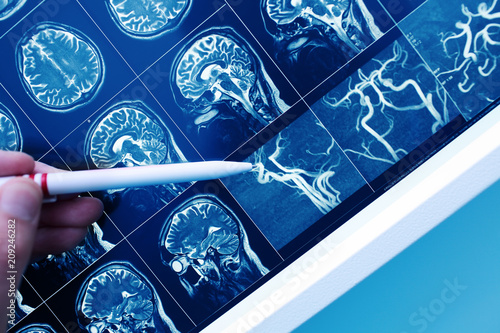Doctor pointing with pen to the brain blood vessel on the MRI image photo