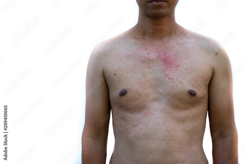 Fototapeta premium Rashes on human skin