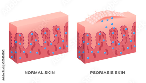 skin disease vector / psoriasis