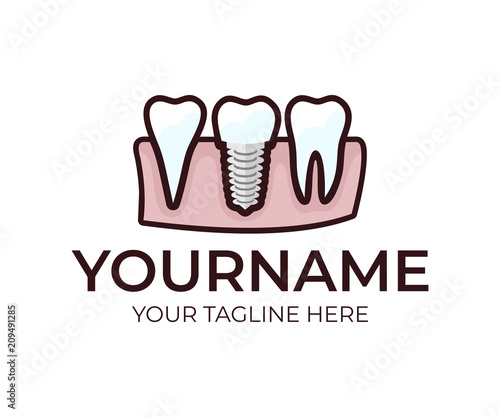 Stomatology, dental implant, denture and teeth, logo template. Medical, dental tooth, vector design. Dentistry illustration