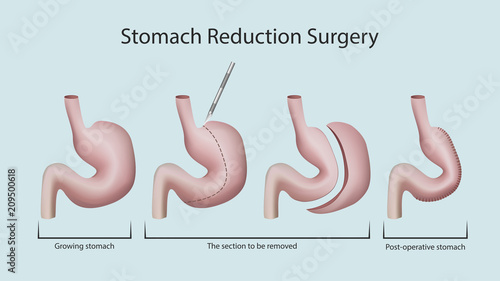 Stomach reduction surgery