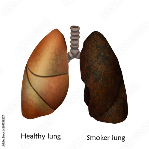 Human lungs. Healthy lung and smoker lung. Anatomy vector illustration. White background.