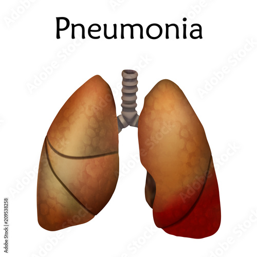 Human lungs. Pneumonia. Anatomy vector illustration. White background.