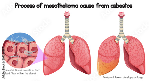 Process of mesothelioma cause of asbestos