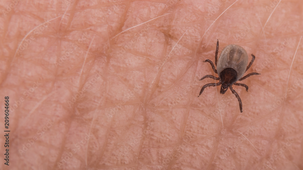 Small deer tick on human skin close-up. Ixodes ricinus. Dangerous biting parasite on detail of the epidermis with light hairs. It carries encephalitis, Lyme borreliosis, babesiosis and ehrlichiosis. Small deer tick on human skin close-up. Ixodes ricinus. Dangerous biting parasite on detail of the epidermis with light hairs. It carries encephalitis, Lyme borreliosis, babesiosis and ehrlichiosis.