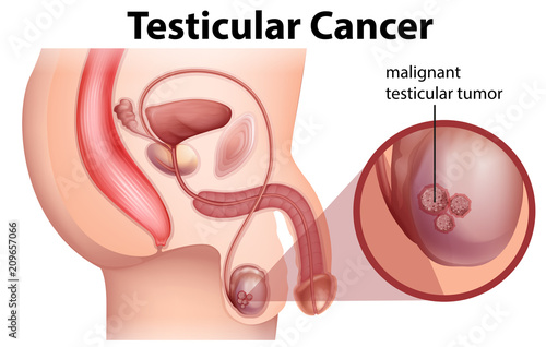 A Male Anatomy of Testicular Cancer