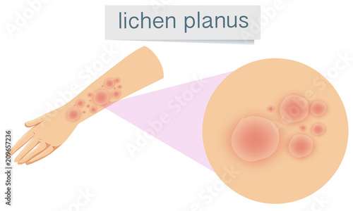 Human Skin with Lichen Planus