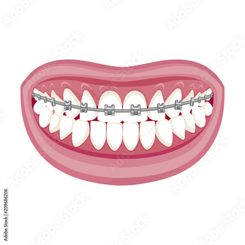 Dentist, orthodontist. Vector illustration. Braces on teeth. open mouth. White background. 