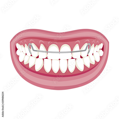Dentist, orthodontist. Vector illustration. Braces on teeth. open mouth. White background. 