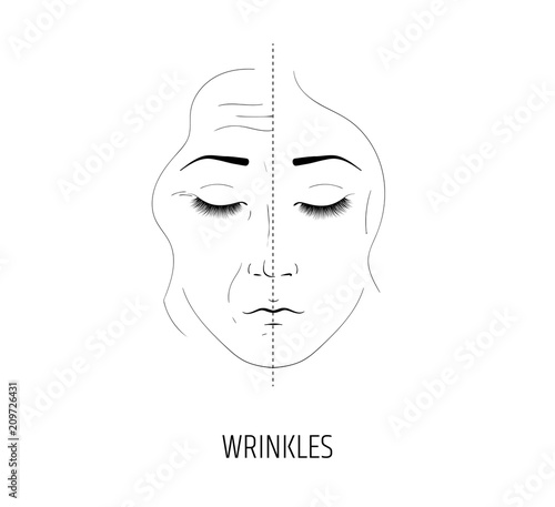 Laser facial rejuvenation. Anti-wrinkle and anti-aging treatment. The effect of the salon procedure. Injection of geuloron acid or botox for facelift. Cream for age-related skin care