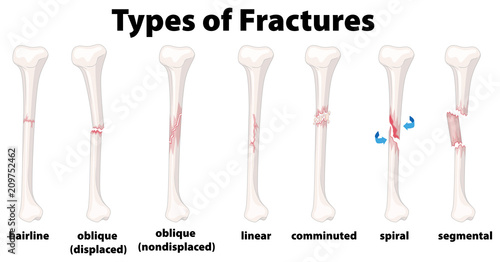 Fototapeta A Set of Bone Fractures