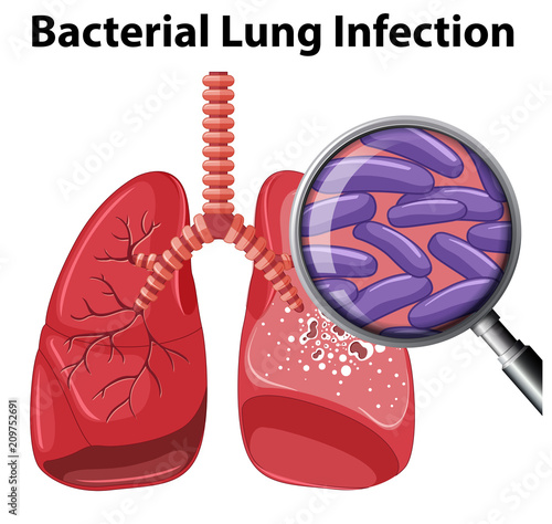 A Bacterial Lung Infection on White Background