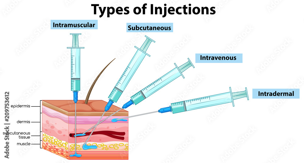 Types Of Injections On White Background Stock Vector Adobe Stock types-of-injections-on-white-background-stock-vector-adobe-stock