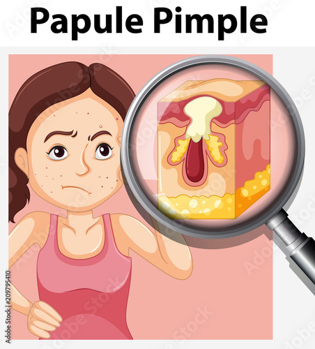 A Papule Pimple on Teenager Face