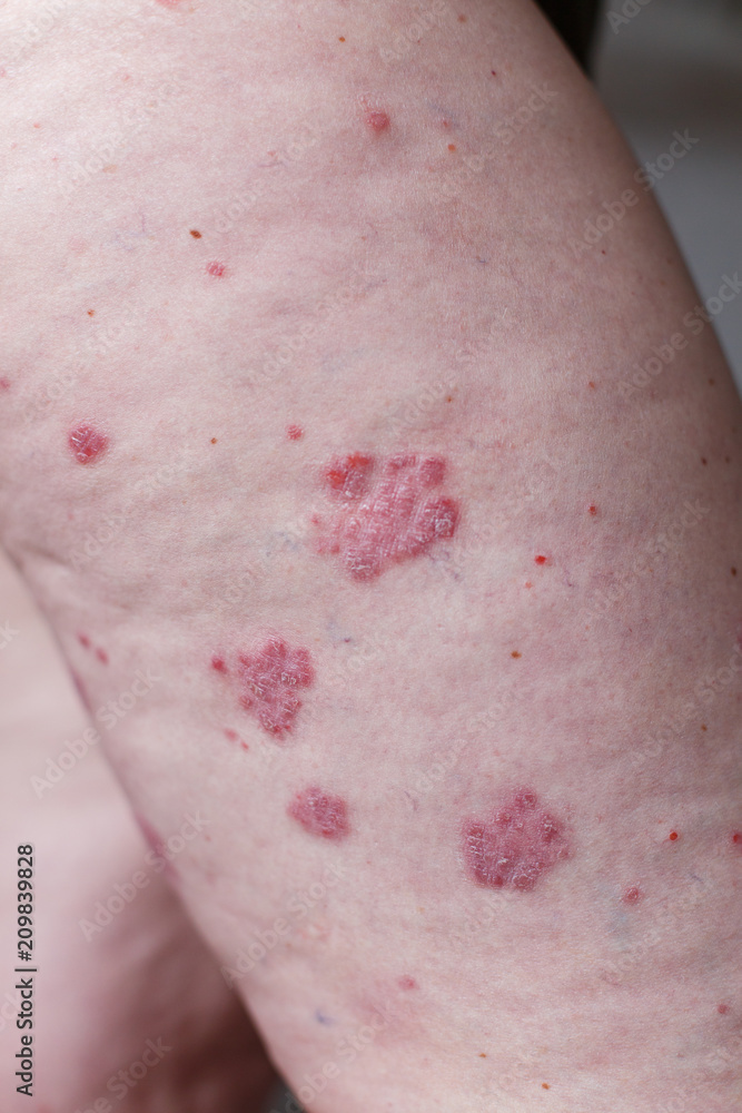 Allergic rash eczema skin on leg of Psoriasis and eczema skin with big red Health concept Stock Photo | Adobe Stock