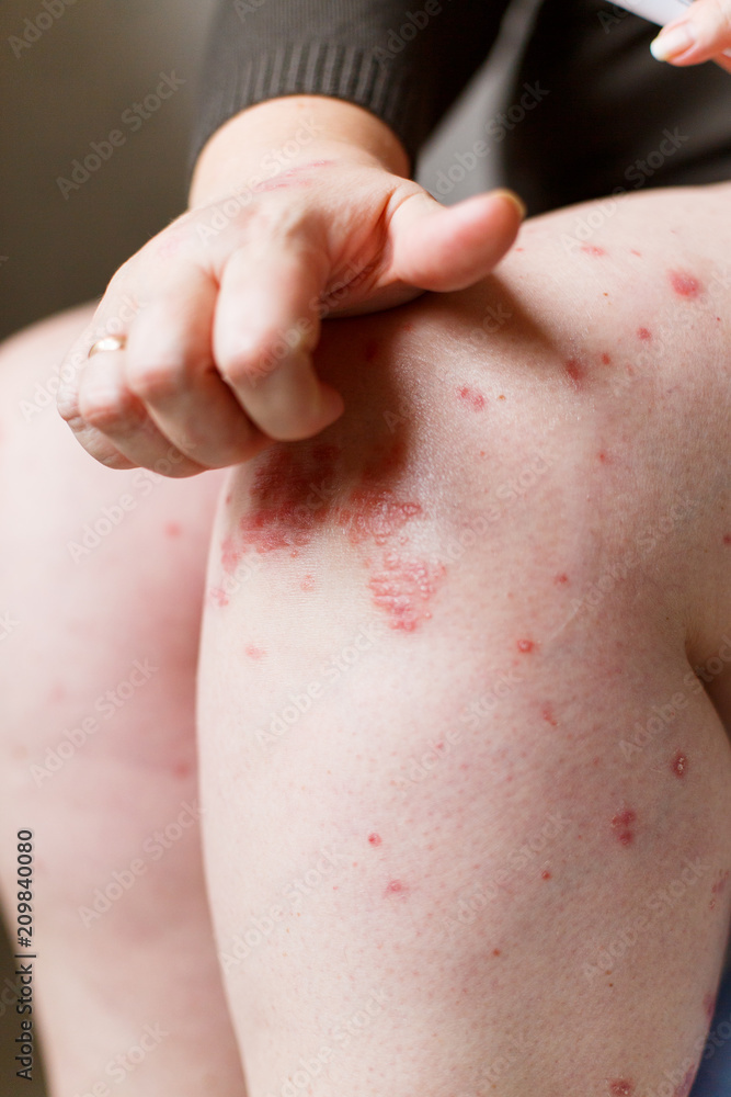Naklejka premium Closeup women itching and scratching psoriasis spots by hand. Psoriasis or eczema on the skin. Atopic allergy skin with red spots