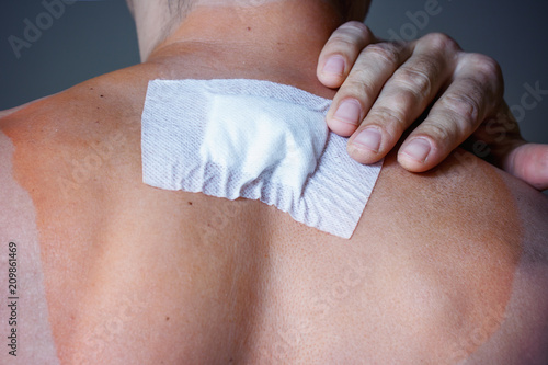 A wound stuck on the back of a man after removal of a fibroma, a birthmark. Close-up, toned