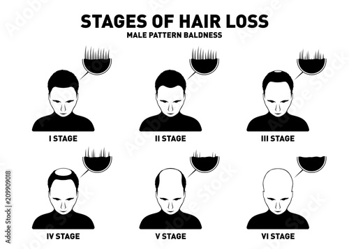 Hair loss. Stages and types of male hair loss. Male pattern baldness. Head  of hairy and bald man in top view Stock Vector | Adobe Stock