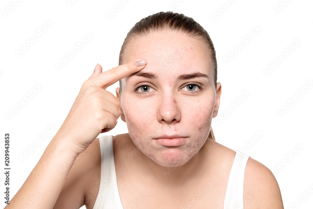 Young woman with acne problem on white background Young woman with acne problem on white background