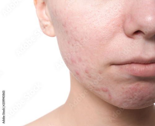 Young woman with acne problem on white background