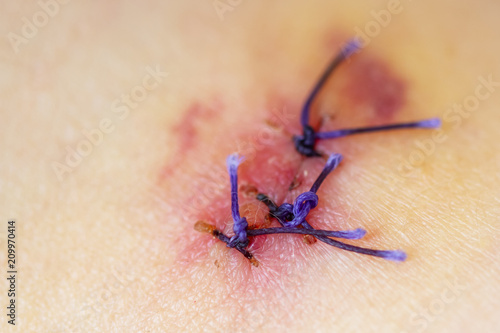 Photos Scar from operation suture with a blue fiber