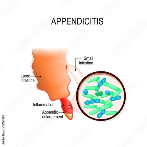 Appendicitis. Human appendix and bacterial growth inside the appendix causing inflammation.